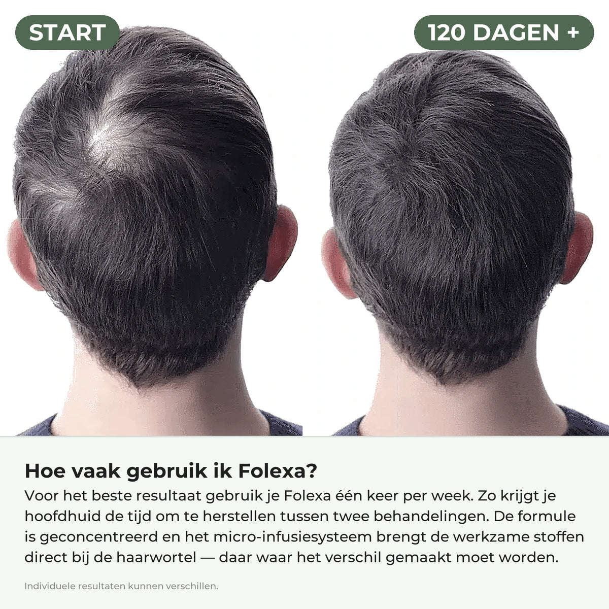 Voor en na 120 dagen, met uitleg hoe vaak je Folexa gebruikt