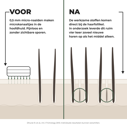 Doorsnede hoofdhuid voor en na micro-infusie